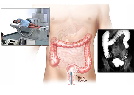 Radiografías con contraste de abdomen