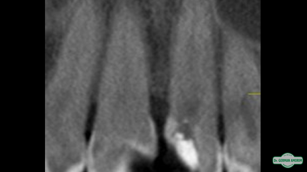 Endodoncia