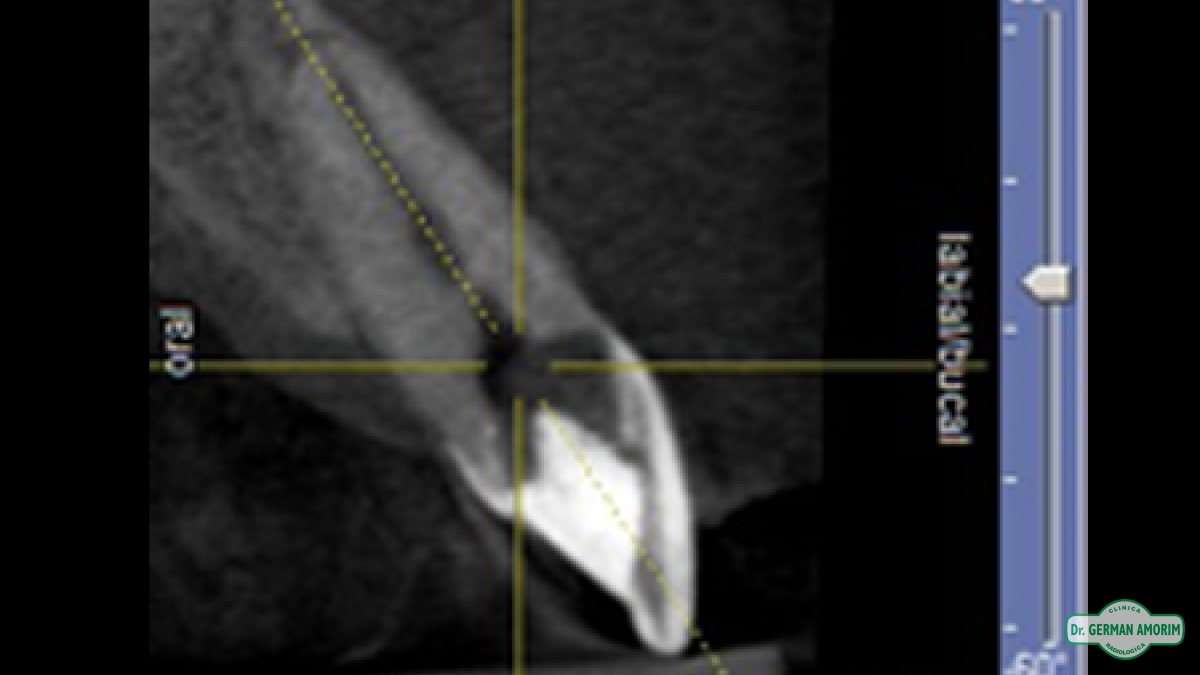 Endodoncia