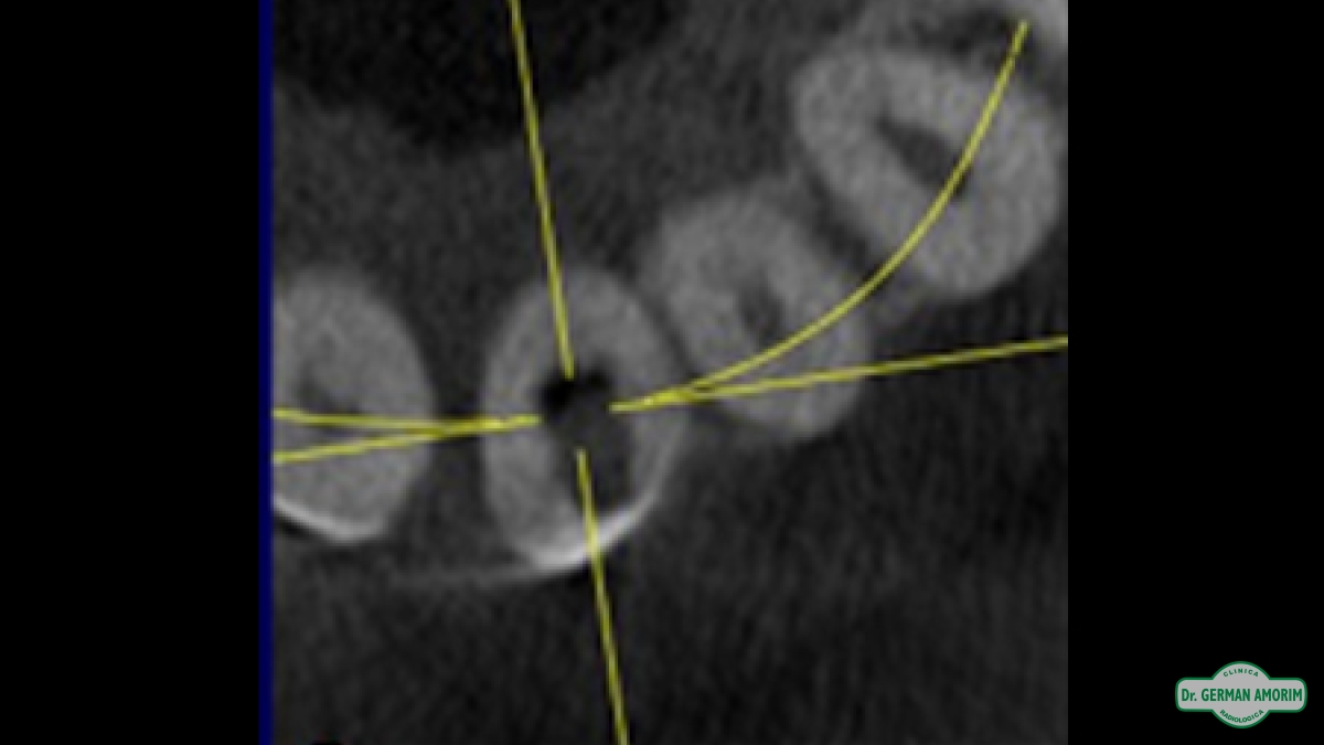 Endodoncia