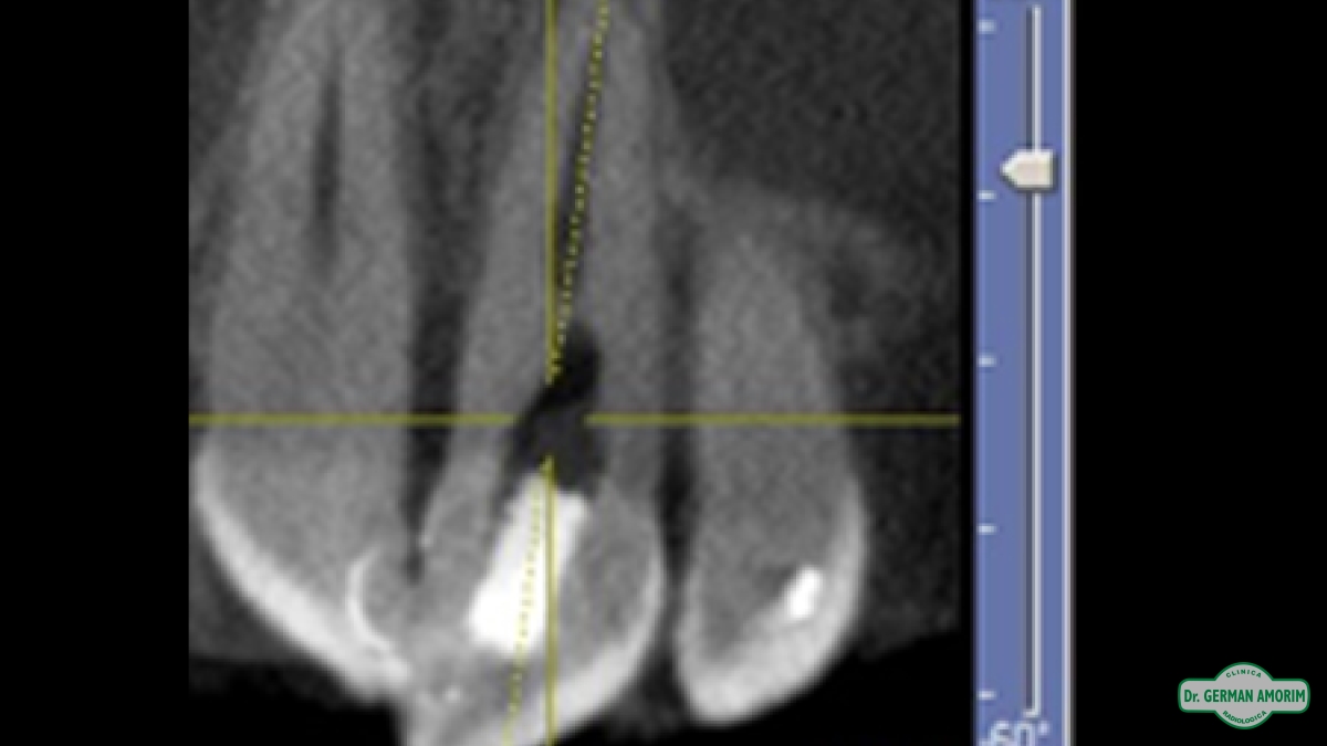 Endodoncia