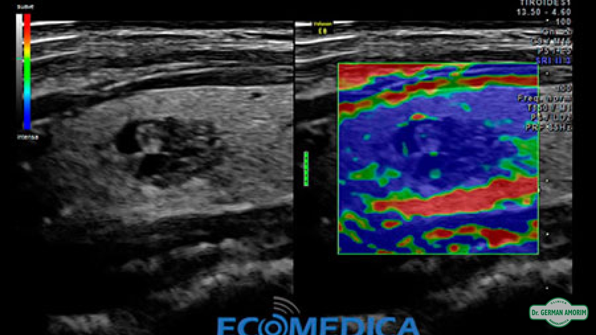 Ecografía Elastografía