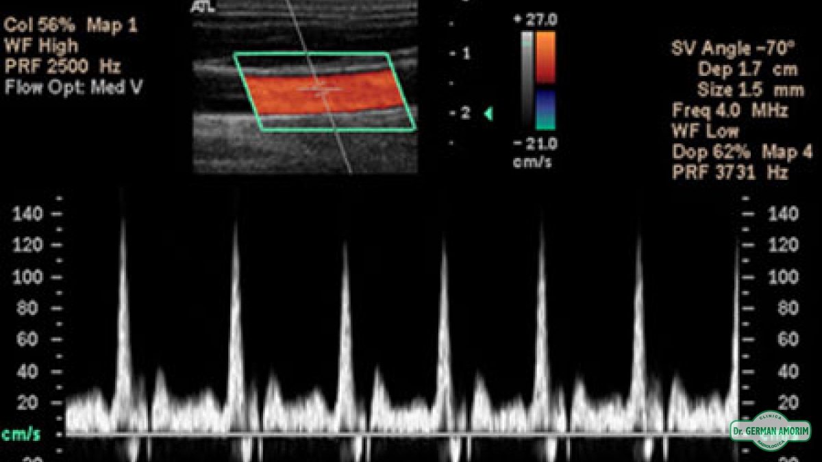 Ecografía Ecodoppler