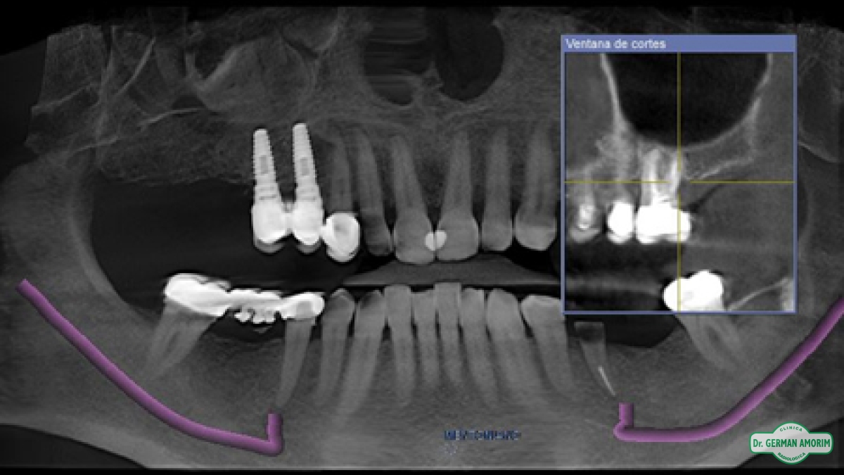 Implantes Dentales