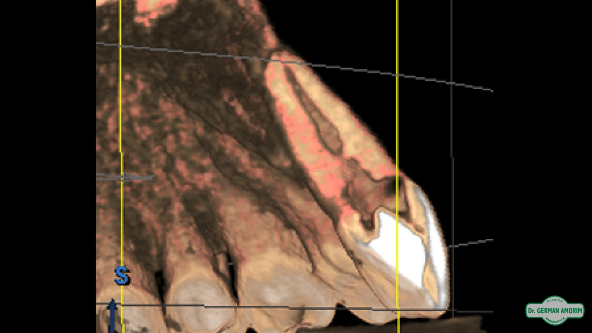 Endodoncia