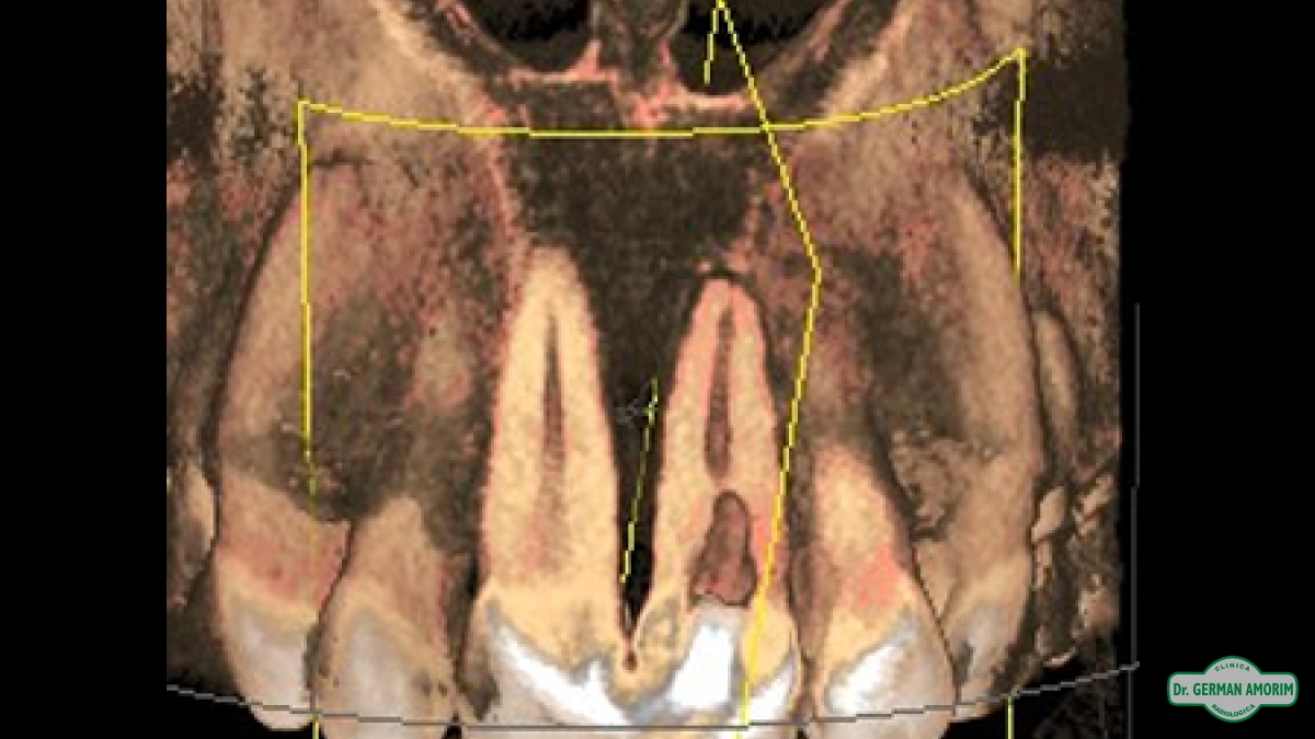 Endodoncia