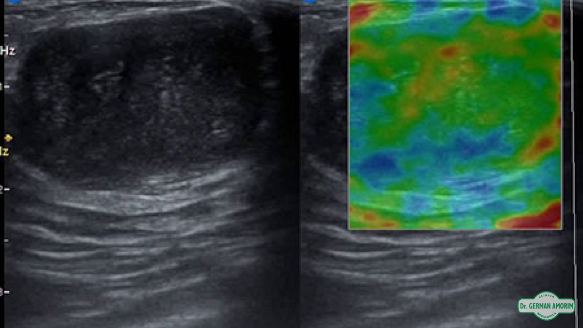 Ecografía Elastografía