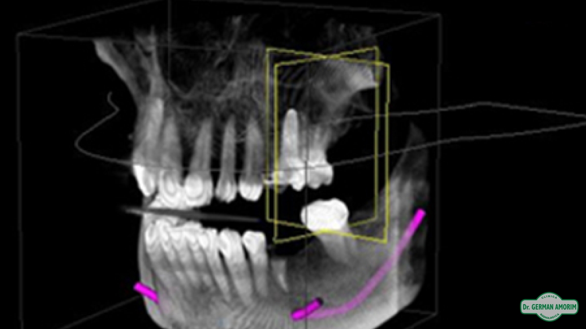 Implantes Dentales