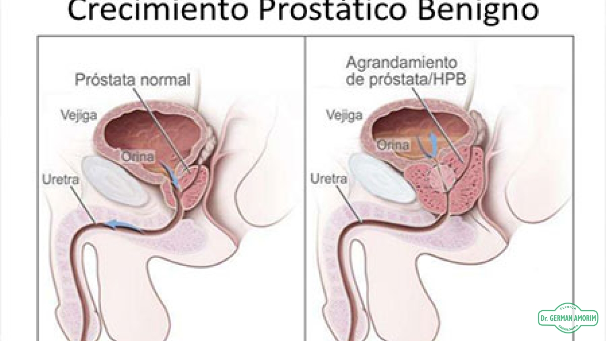 ec prostàtica