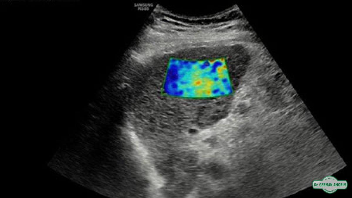Ecografía Elastografía