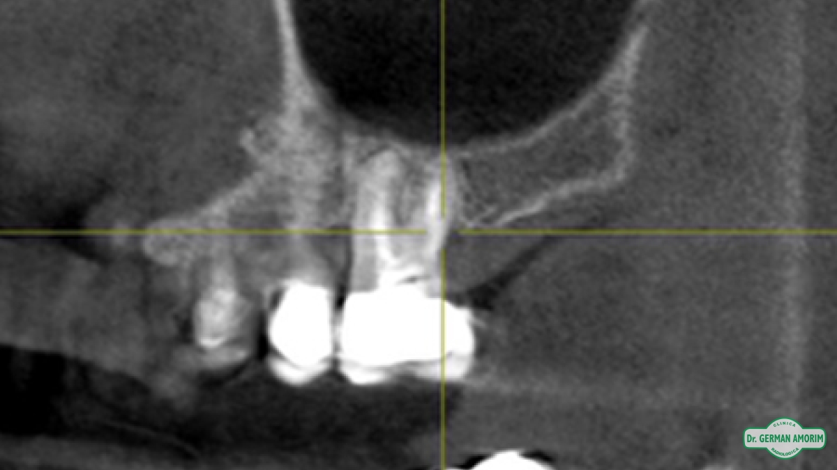 Implantes Dentales