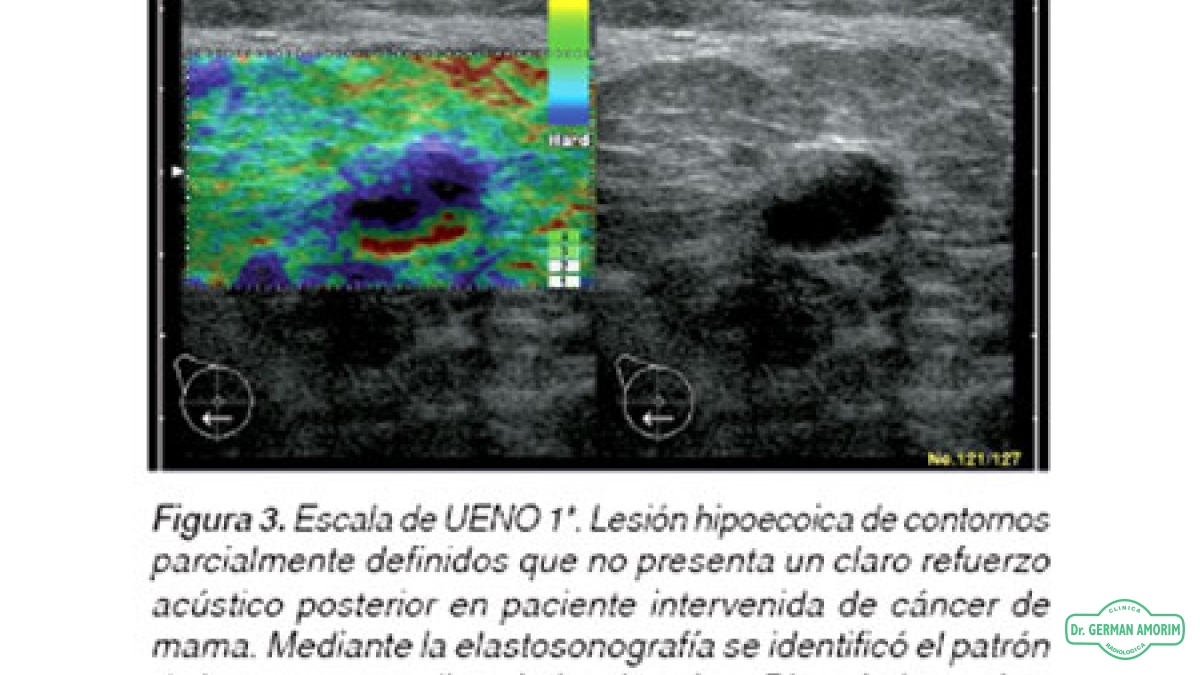 Ecografía Elastografía