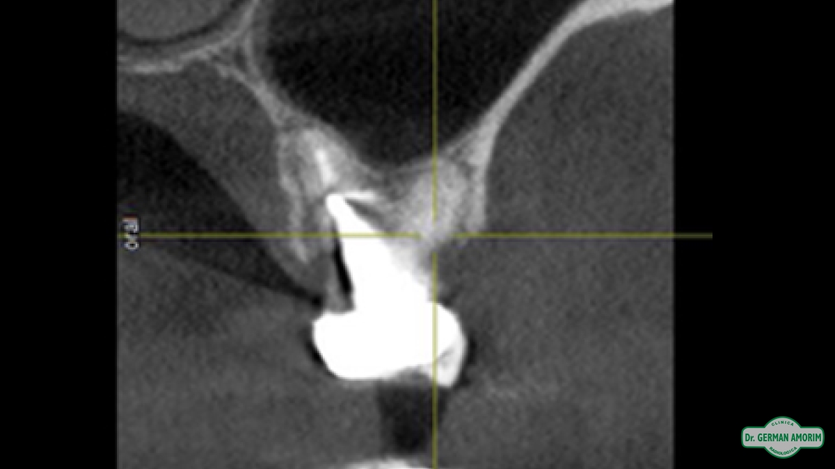 Implantes Dentales