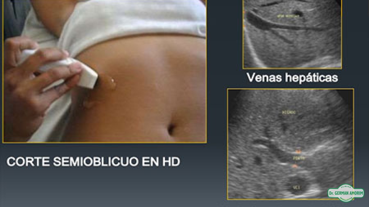 Ecografía de Punciones Hepáticas