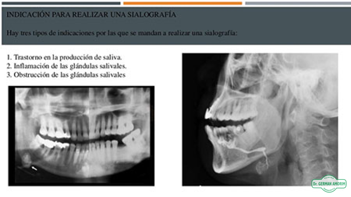 Sialografía