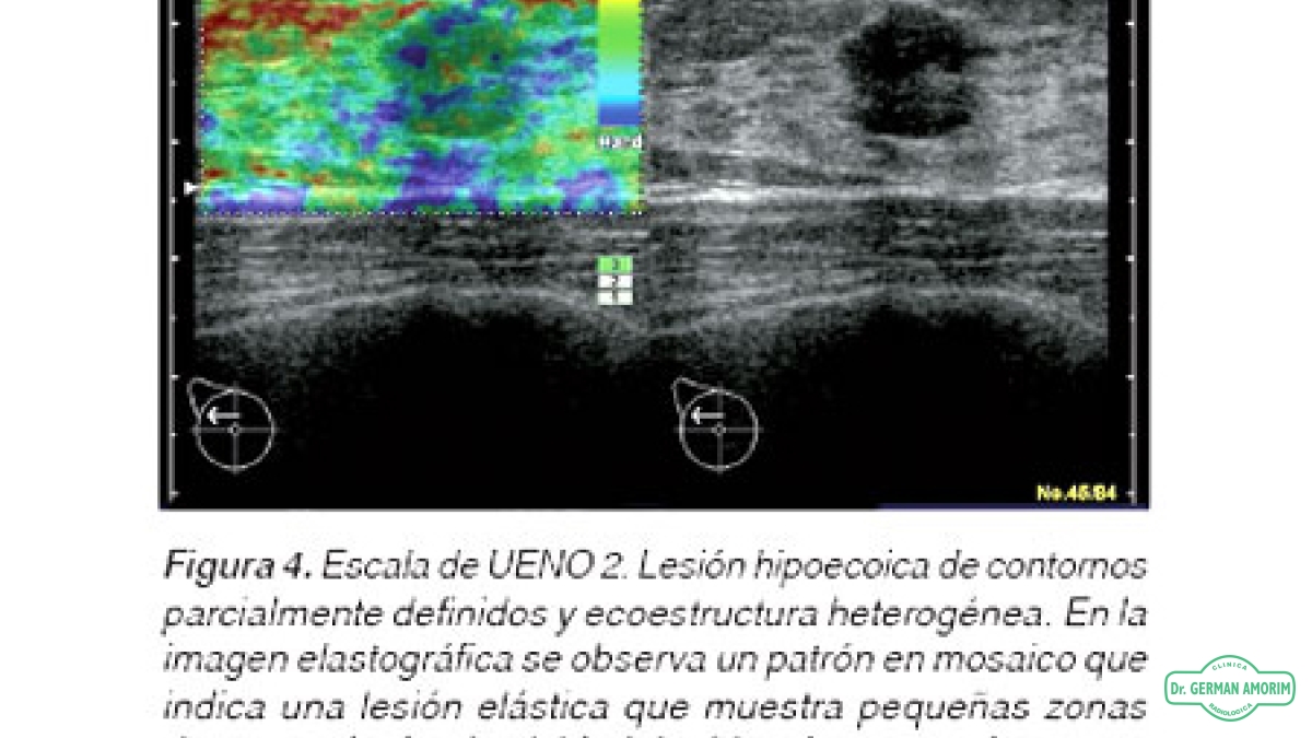 Ecografía Elastografía