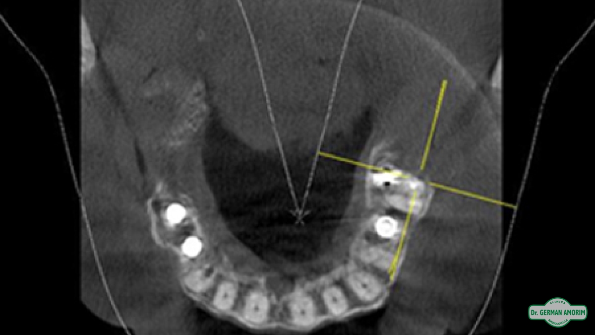 Implantes Dentales