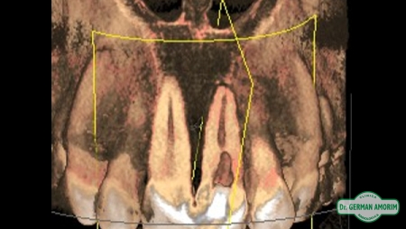 Tomografía Odontológica